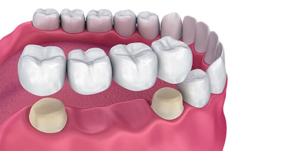 Dental Bridges Surrey