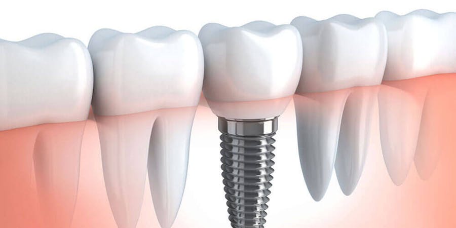 Dental Implants Surrey