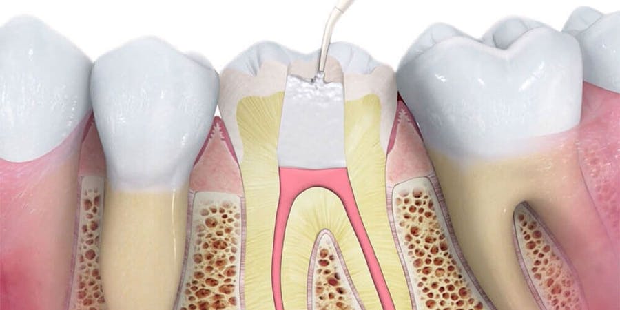 Root Canal Treatment Surrey
